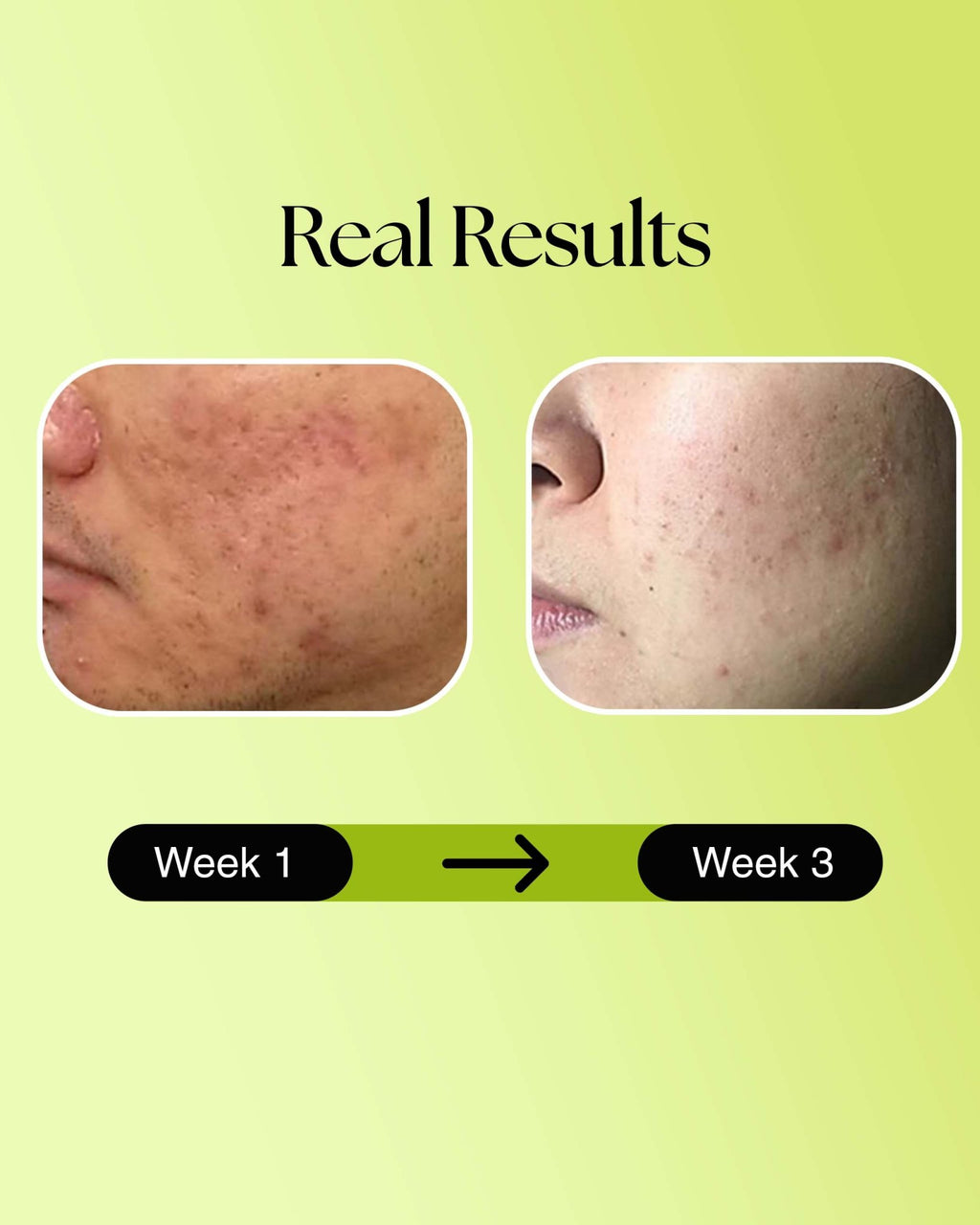Anti Acne Face Wash: Foaming Face wash